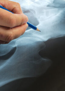 Louisville Hip Replacement Failure