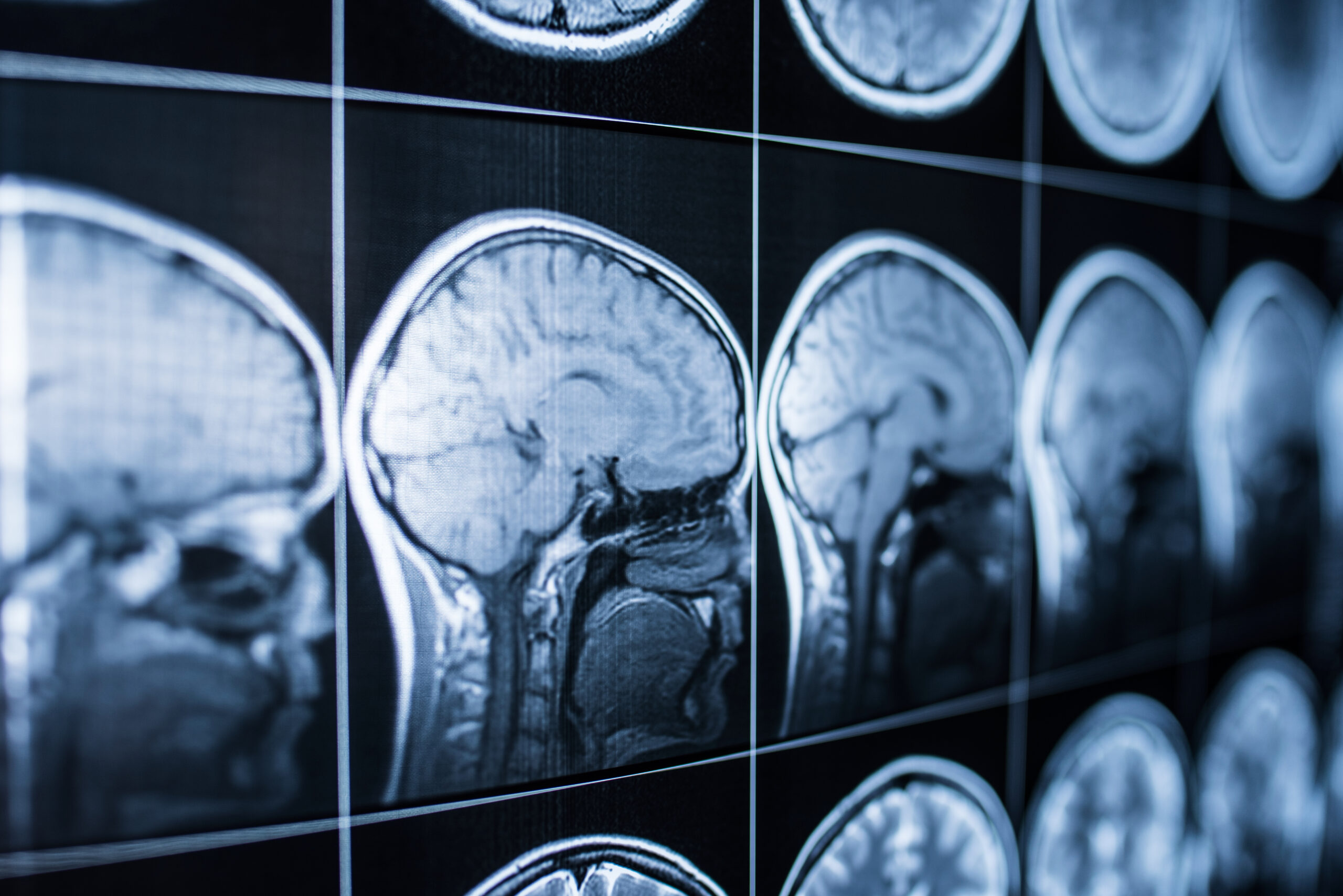 What Counts as a Traumatic Brain Injury in Ohio Cases?