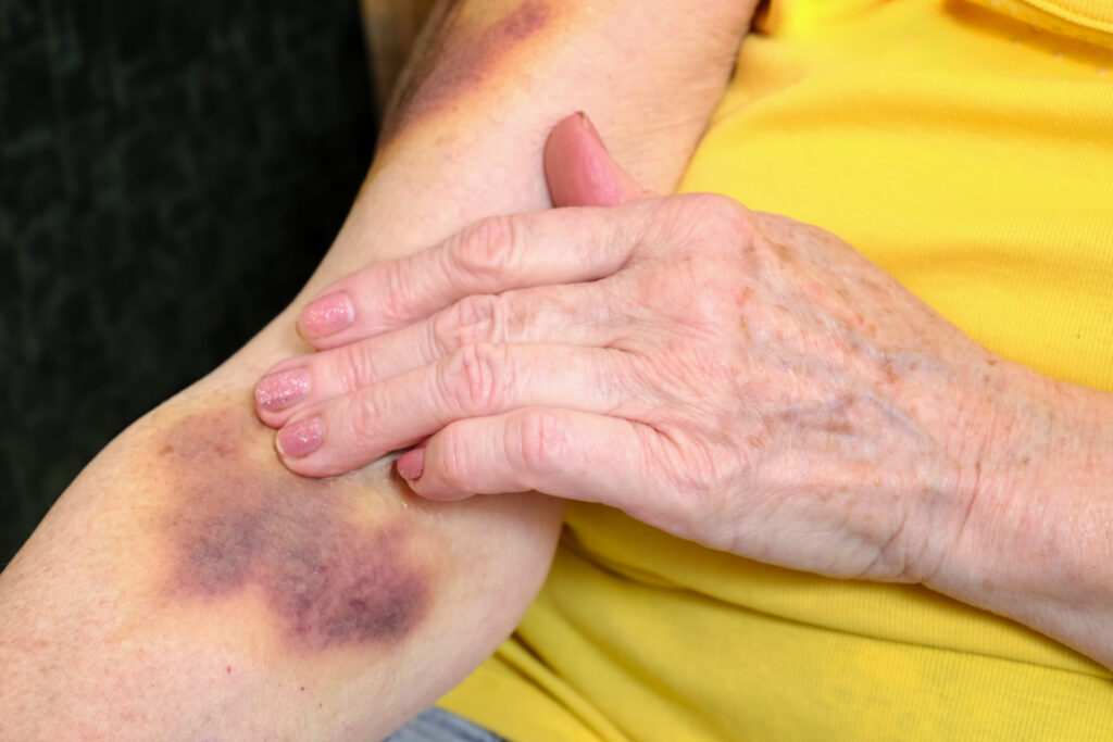 What Is Unreasonable Physical Restraint in Nursing Homes?