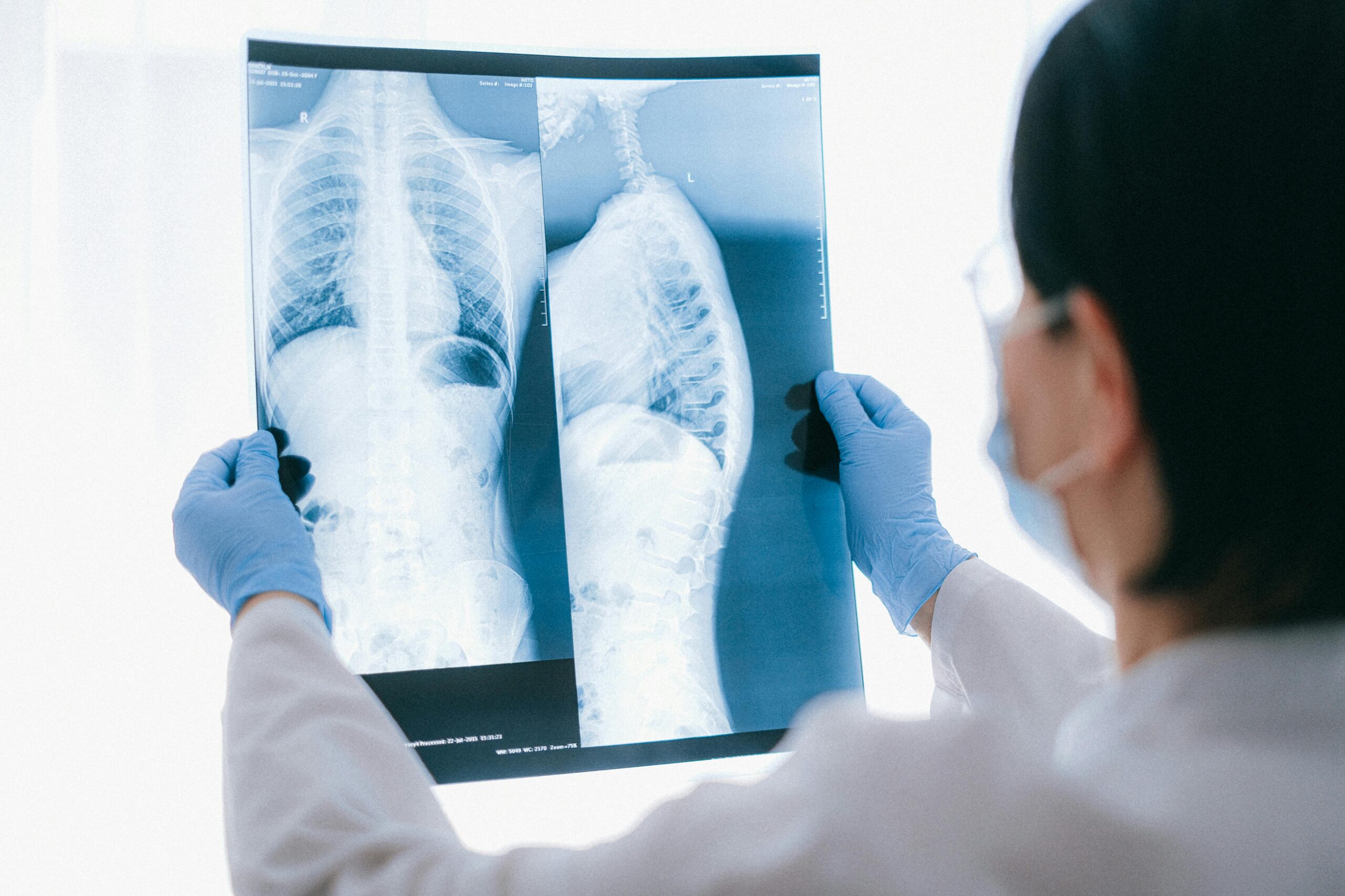 Spinal Cord Injuries in Cleveland