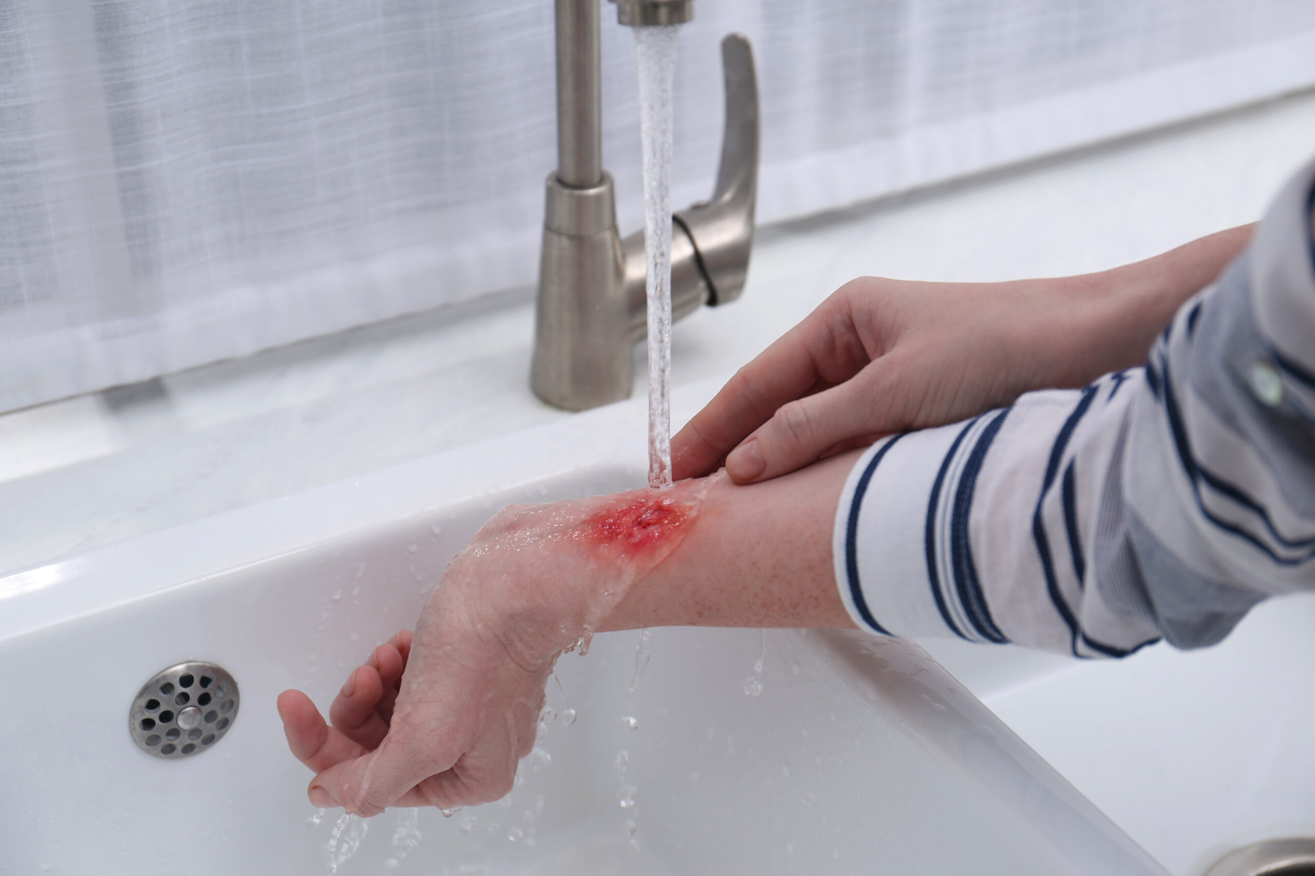 What Should You Know About Burn Injuries?